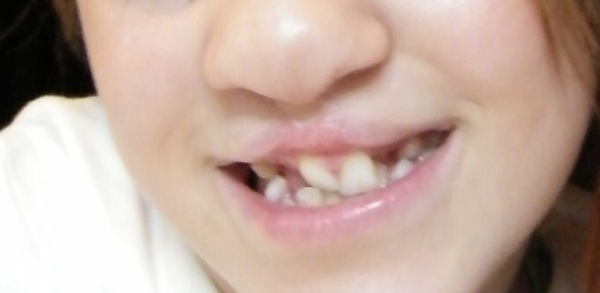 What was your dcs teeth like before braces? (NHS)
