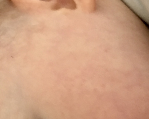To ask about tiny pinprick spots on baby's face that appear and disappear?