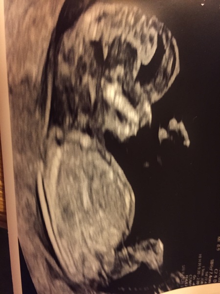 Gender guesses on 12 week scan