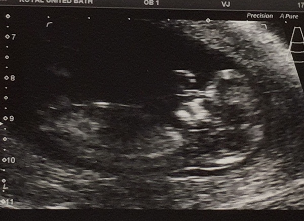 Anxiety prior to 12 week scan next week