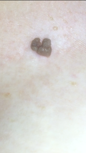 Mole of skin tag (picture attached)