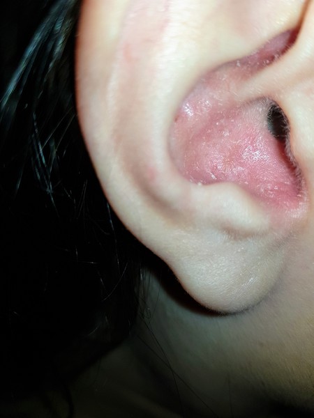 What can I use in my ear?! Warning pic attached
