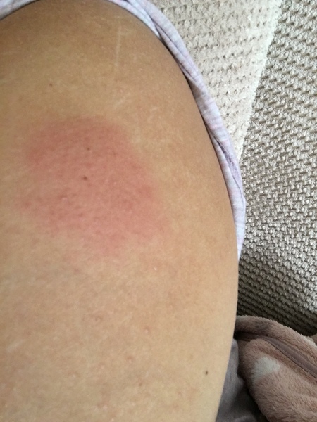 Flu Jab whilst pregnant - my arm?!