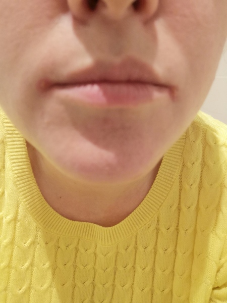 Persistent cold sores