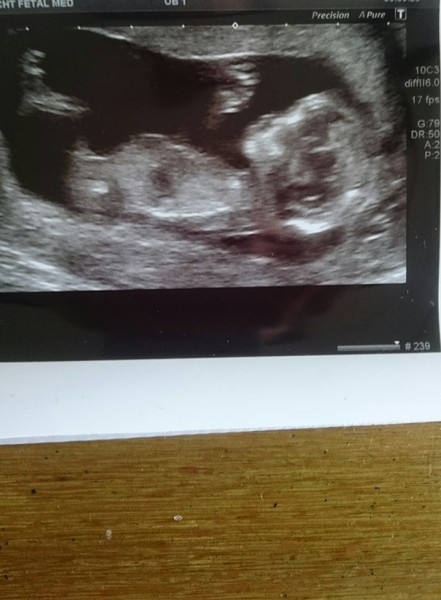 Just for fun 12 week scan guesses!