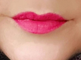 Should I get my lips filled?