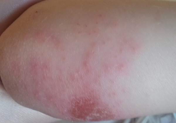 Any nurses about -icky looking skin around DD's grazed elbow