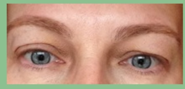 Eyelid stickers