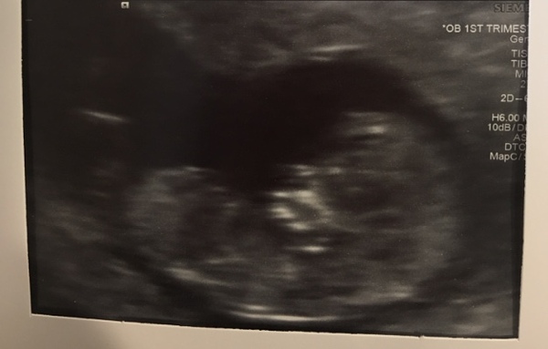 12 week scan! Nub theory - Any ideas??? 😄😄😄