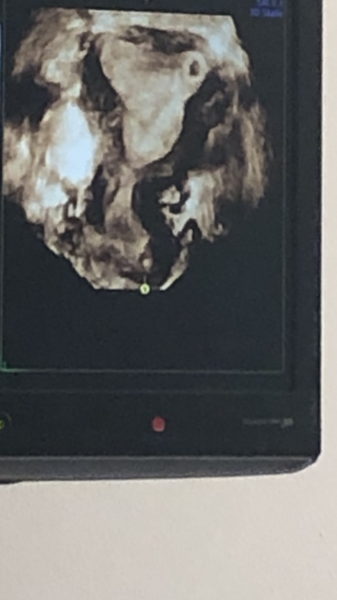 Left side early pregnancy - arcuate uterus - need reassurance!
