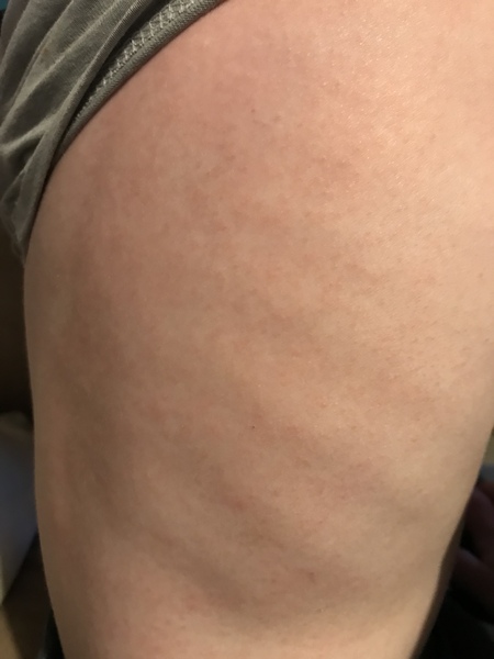 Scarlet fever?