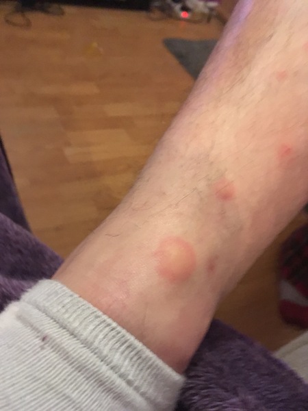 What is biting me?