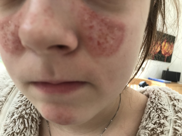 What is this...acne rosacea?