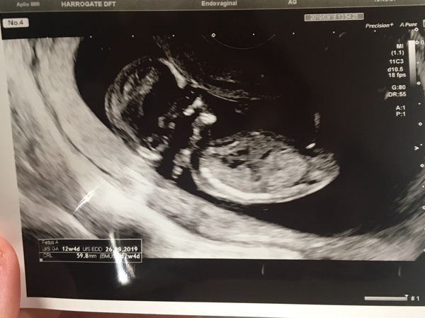 12 week scan! Nub theory - Any ideas??? 😄😄😄
