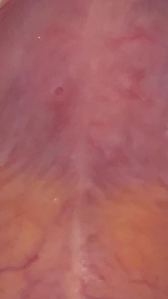 Any ideas .. mouth spot /ulcer ??