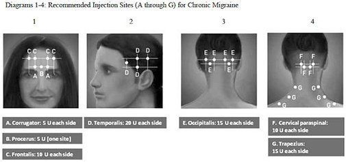 HAs anyone had Botox for headaches?