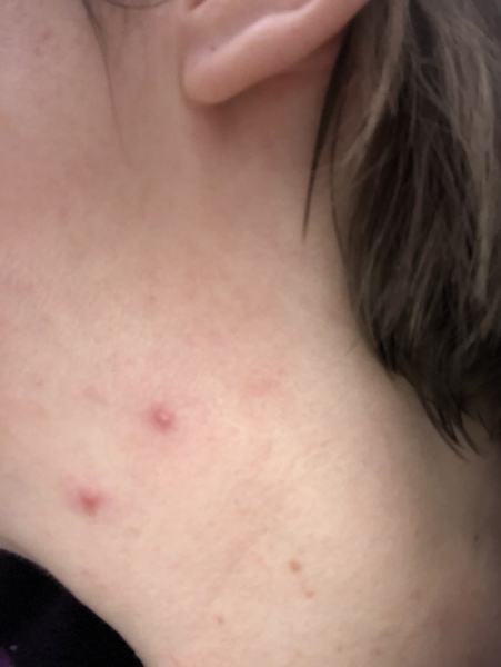 Can anyone help me with adult ‘acne’ please