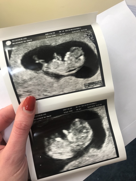 Symptoms gone at 9 weeks