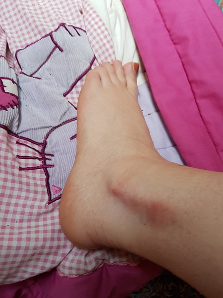 Google suggests I should go to a&e.  Photo of my ankle.