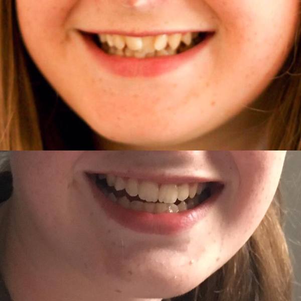 What was your dcs teeth like before braces? (NHS)
