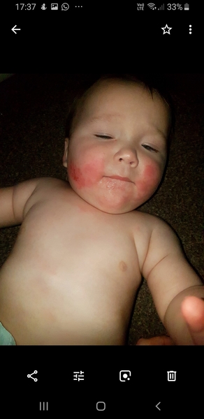 Cows milk allergy / rice allergy - any experience?