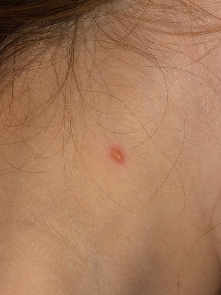 Is this chicken pox?