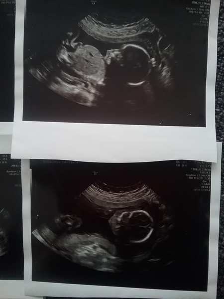 Gender guesses from 20 week scan pics please? Due next week!