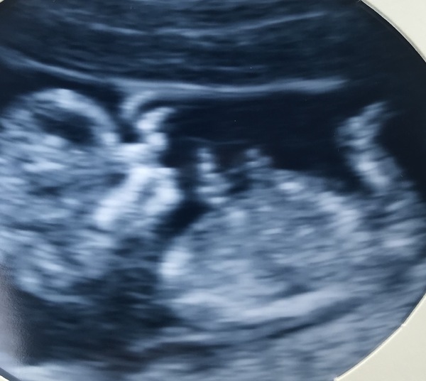 Boy or girl guesses?