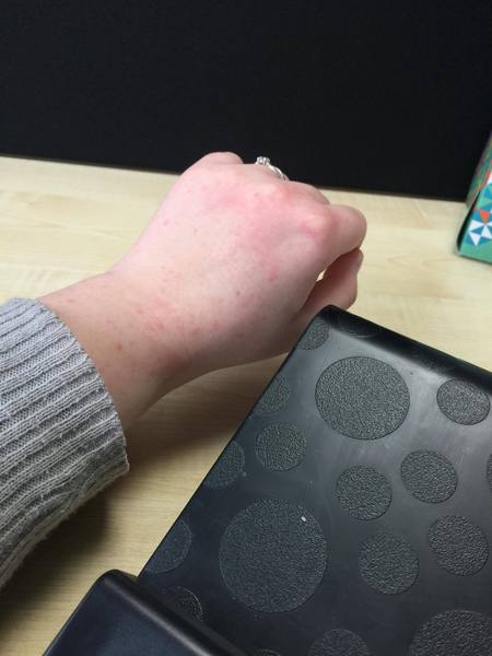 Help, Rash Over hands & Arms (picture Included)
