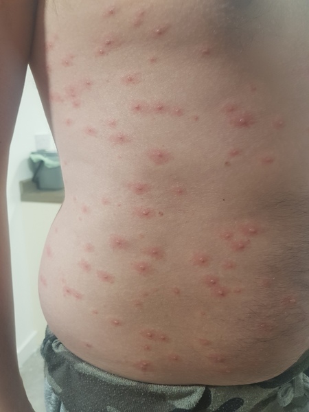 DH has rash - chicken pox or something else?