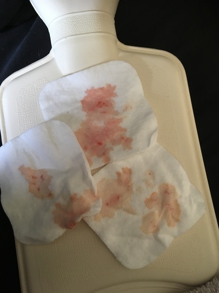 Flu, ear infection and bleeding ear!