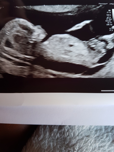 13 week nub theory