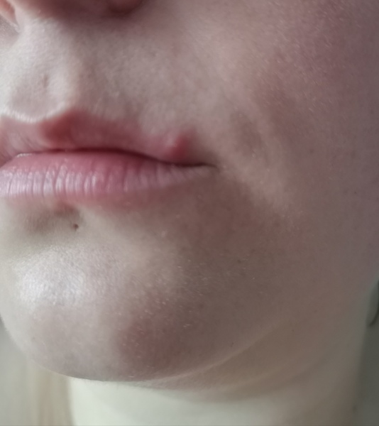Is this a spot or a cold sore?