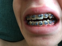 What was your dcs teeth like before braces? (NHS)