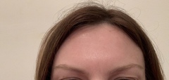 Your experiences of botox?