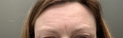 Your experiences of botox?