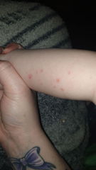 Pox or Scabies? (PHOTOS)