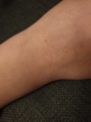 Could this really be scabies?