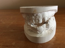 What was your dcs teeth like before braces? (NHS)