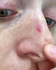 Burst blood vessels on skin (small clusters) esp. nose