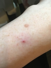 Burst blood vessels on skin (small clusters) esp. nose