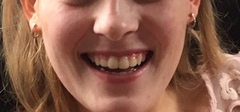 What was your dcs teeth like before braces? (NHS)