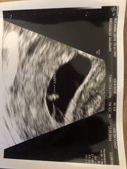 Faint Positive Pregnancy Test