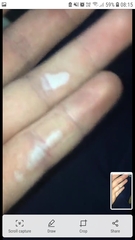 Burned hand