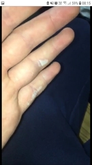 Burned hand