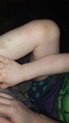 Pox or Scabies? (PHOTOS)