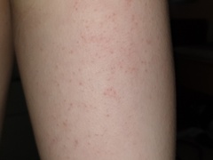 Could this really be scabies?