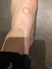 Any doctors about? Freaking out about lump on foot