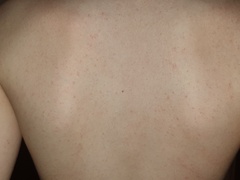 Could this really be scabies?