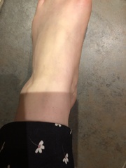 Any doctors about? Freaking out about lump on foot